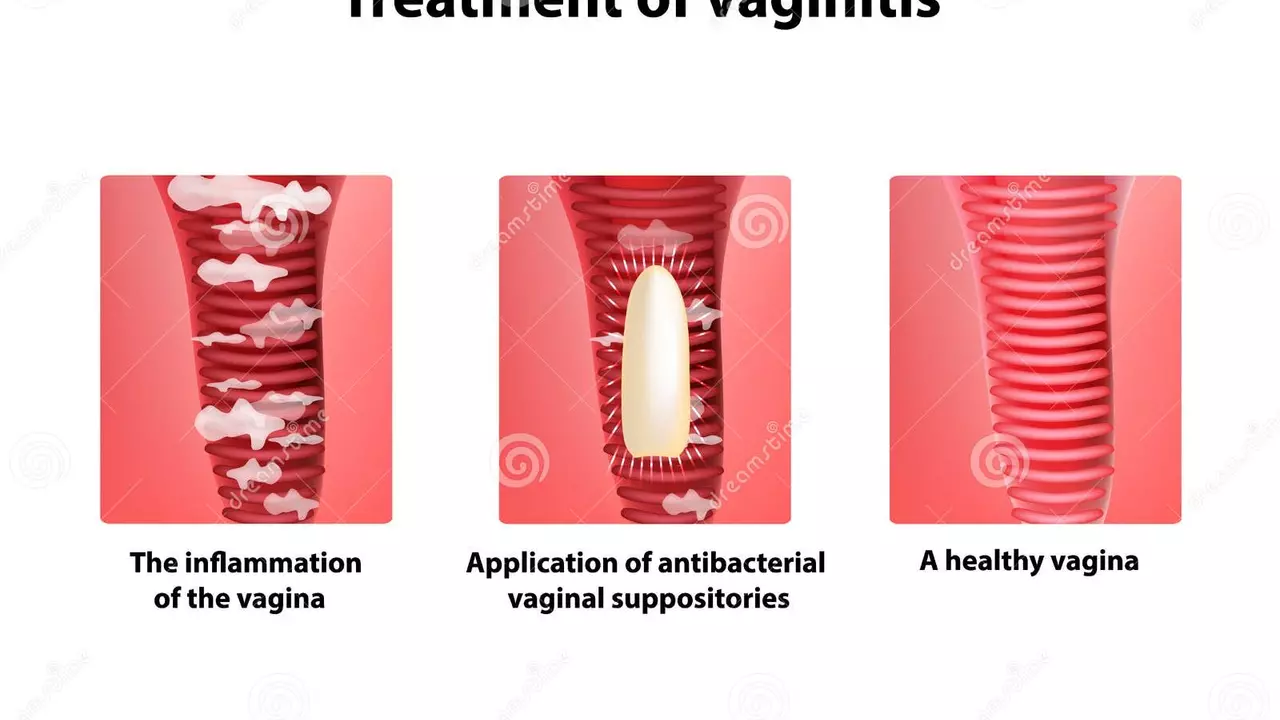 Comment Prévenir les Brûlures Vaginales : Conseils pour Maintenir la Santé Vaginale