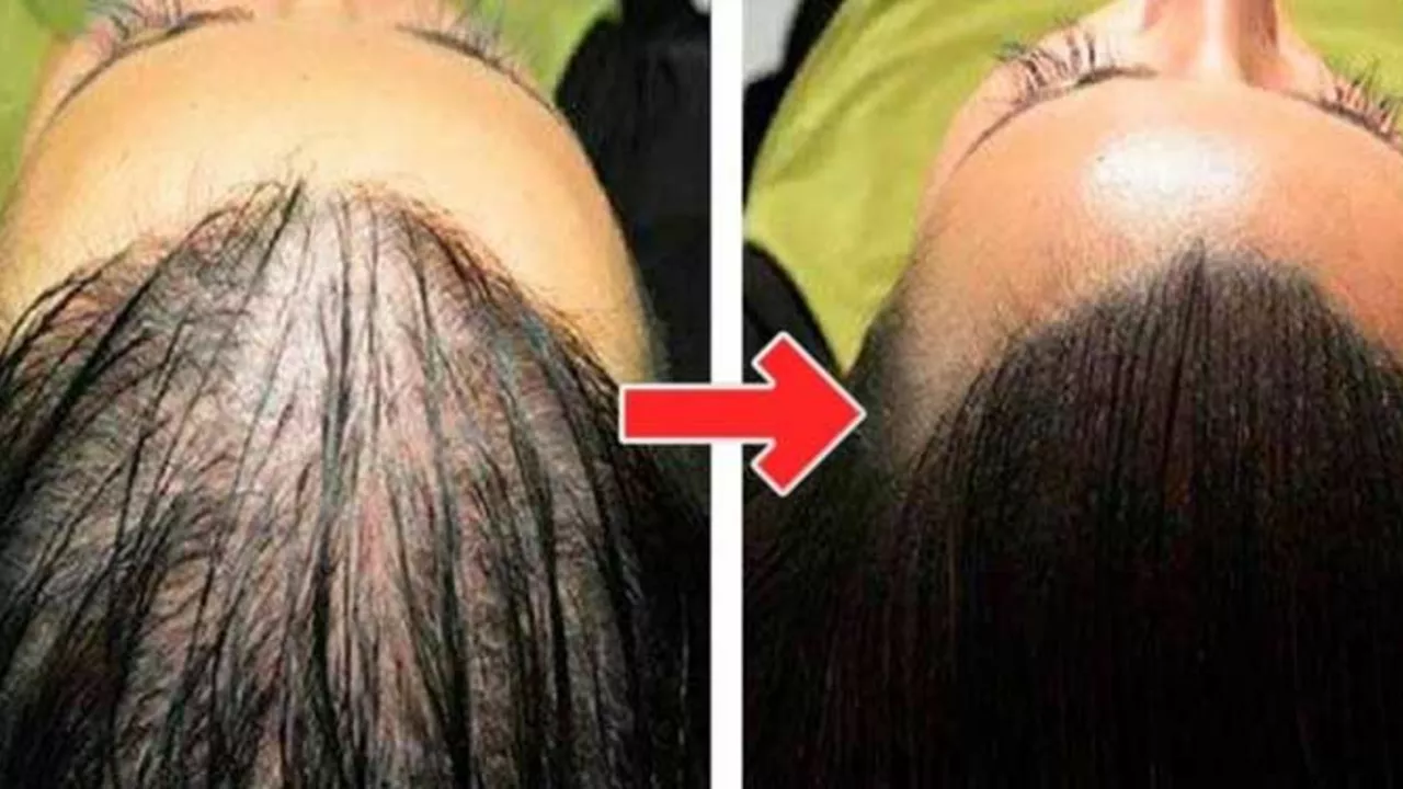 Minoxidilfinasteride et repousse des cheveux: à quoi s'attendre pendant le traitement
